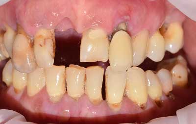 Фото до имплантации зубов при пародонтите