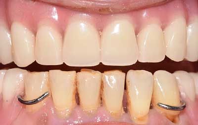 Фото после имплантации зубов при пародонтите