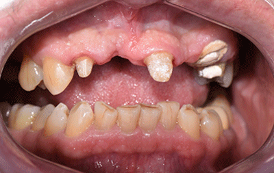 Фото до имплантации передних зубов