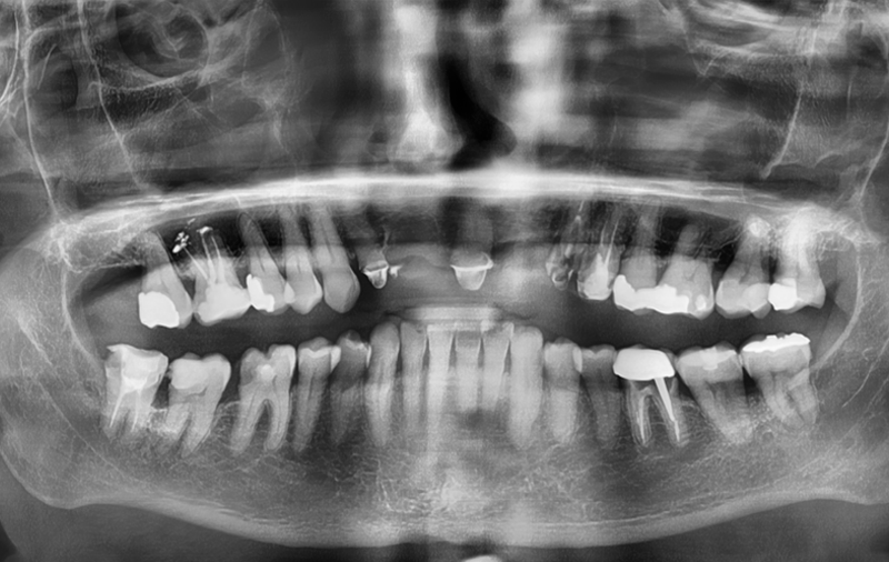 Снимок Фото до имплантации передних зубов