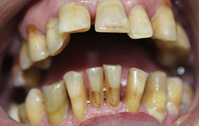 Разрушение почти всех зубов в полости рта