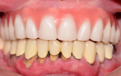 восстановление зубов на верхней челюсти