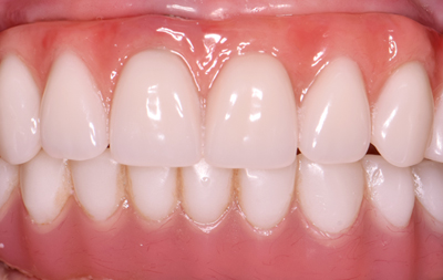 Перепротезирование зубов на верхней челюсти