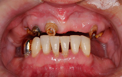 фото зубов до имплантации