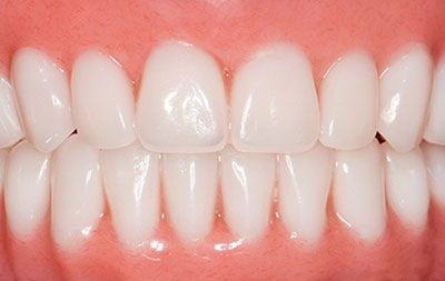 Проведение имплантации зубов по протоколу all-on-4