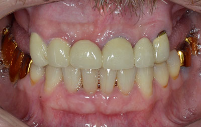 Фото зубов пациента на первом приеме в клинике