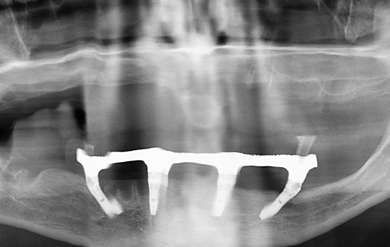 Снимок восстановление зубов на нижней челюсти по технологии All-on-4