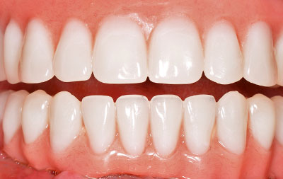восстановление зубов на нижней челюсти по технологии All-on-4