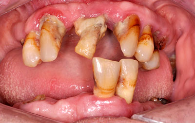Множественное отсутствие зубов на двух челюстях, запущенный пародонтит 