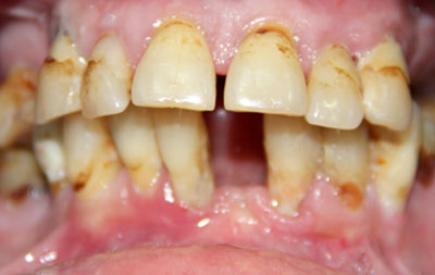 Частичное отсутствие зубов, хронический пародонтит