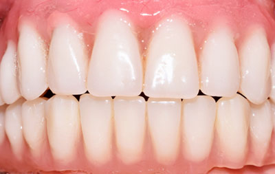 Удаление пораженных зубов и одновременная установка имплантов на обе челюсти по технологии Basal Complex