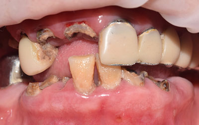 Фото зубов до установки комплекса комплексных имплантатов