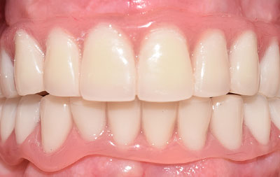 Фото после имплантации и установки адаптационных зубных протезов