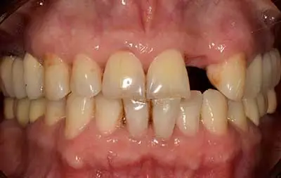 Фото состояния зубов до их восстановления с помощью имплантации