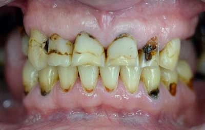 Фото состояния зубов 31 летнего пациента до операции