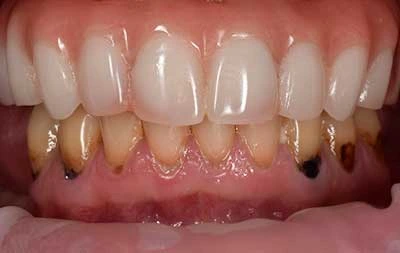 Фото после восстановления зубов верхней челюсти all-on-6