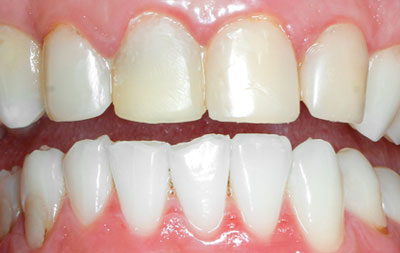 небольшие сколы и также изменение цвета зубов.