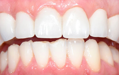 установка 6 виниров на передние зубы верхней челюсти