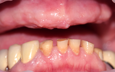 Отсутствие зубов на верхней челюсти