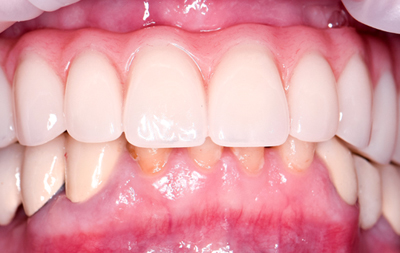 Восстановление всех зубов на верхней челюсти по технологии All-on-4