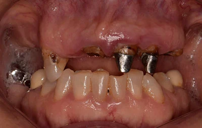 Фото с проблемными зубами до проведения скуловой имплантации зубов