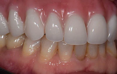 Фото после установки постоянного зубного протеза через 2 года после имплантации зубов