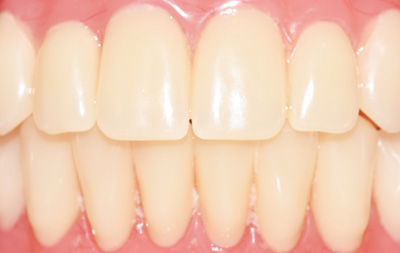 Проведено полное протезирование всех зубов 