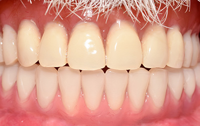 Восстановление всех зубов по технологии All-on-6