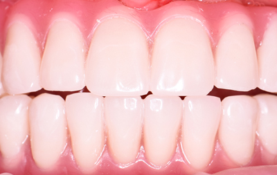 Удаление несостоятельных зубов и одновременная установка базальных имплантов по протоколу Basal Complex