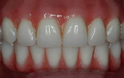 Фото после установки постоянных зубных протезов на импланты