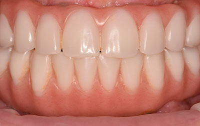 После восстановления зубов имплантацией за 3 дня