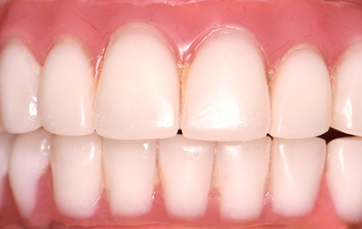 восстановление зубов по протоколу базальной имплантации с применением имплантов Zygomatic 