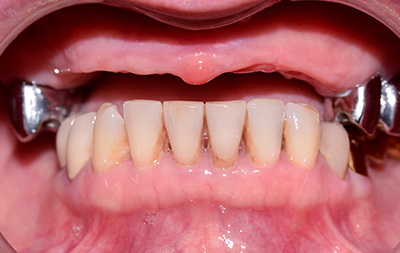 Полное отсутствие зубов и атрофия кости на верхней челюсти