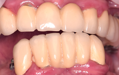 Отсутствие жевательных зубов на нижней челюсти