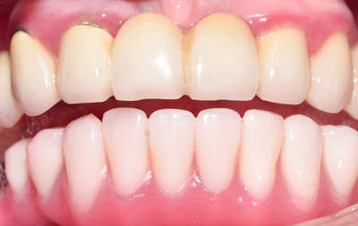 Восстановление зубов на нижней челюсти по технологии All-on-4