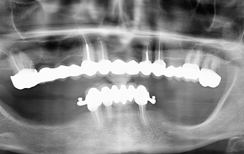 Снимок Отсутствие жевательных зубов на нижней челюсти