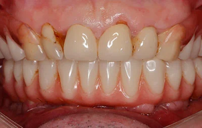 Фото состояния зубов после имплантации All on 6