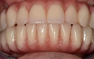 Фото перепротезирования зубов через 2 года после имплантации