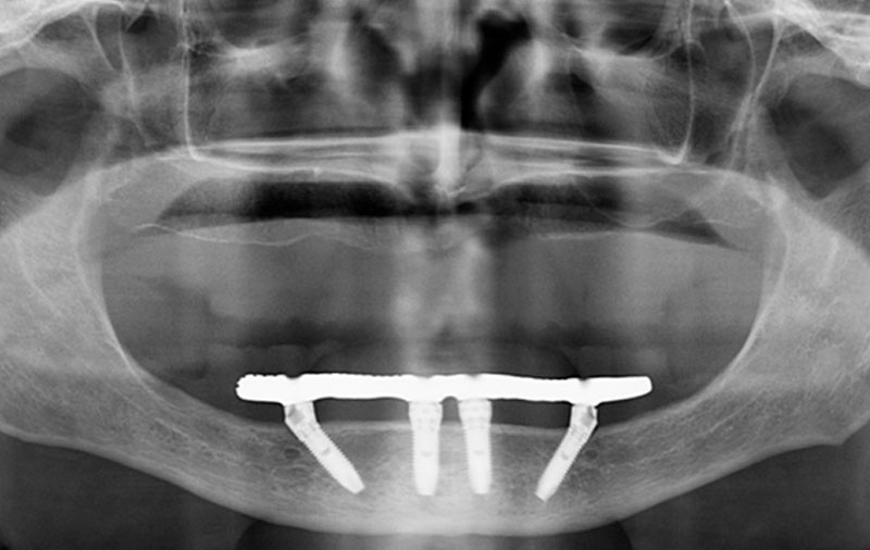 Снимок Фото установленных протезов на импланты на двух челюстях