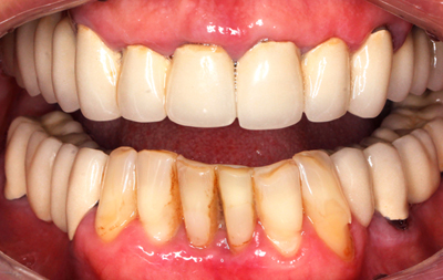 Разрушение опорных зубов под мостовидными протезами