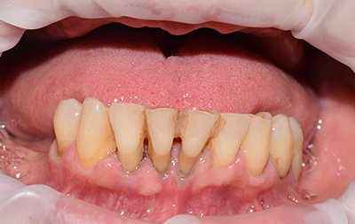 отсутствие зубов на верхней челюсти, атрофия костной ткани