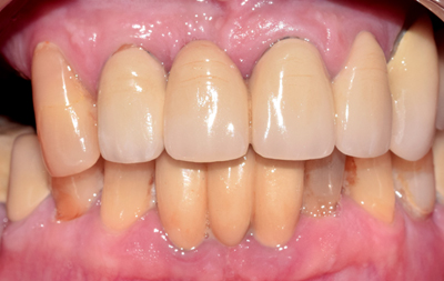 Отсутствие жевательных зубов на верхней и нижней челюстях