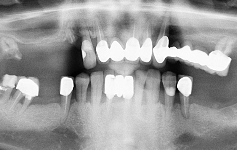 Снимок Отсутствие жевательных зубов на верхней и нижней челюстях