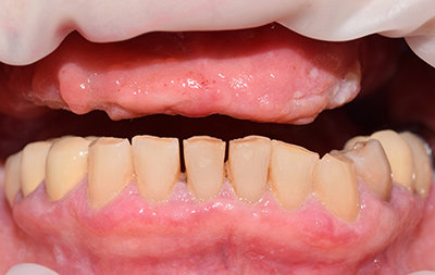 Долгое отсутствие зубов на верхней челюсти