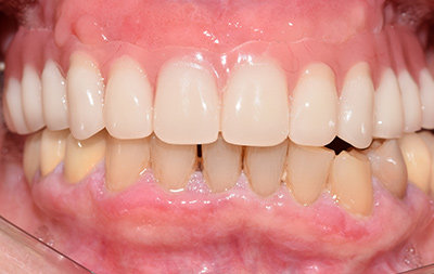 Зубы на верхней челюсти восстановлены