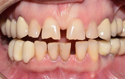 Фото до комплексной комплексной имплантации зубов