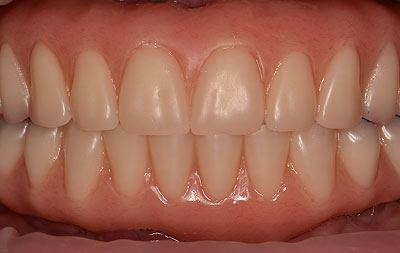 Фото после имплантации зубов с помощью односоставных имплантов