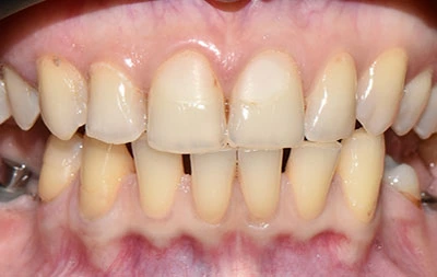 Фото до установки имплантов и виниров на зубы