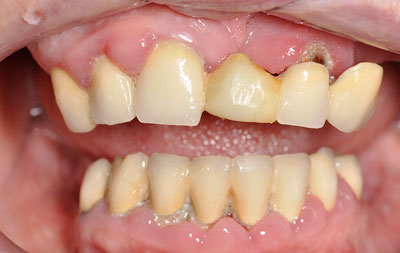Фото до проведения комплексной имплантации зубов методом All-on-4