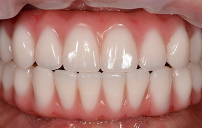 Фото после установки постоянных протезов на зубные импланты